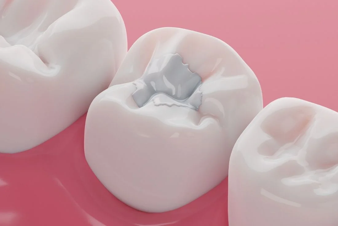 11716 Dentist Composite Fillings