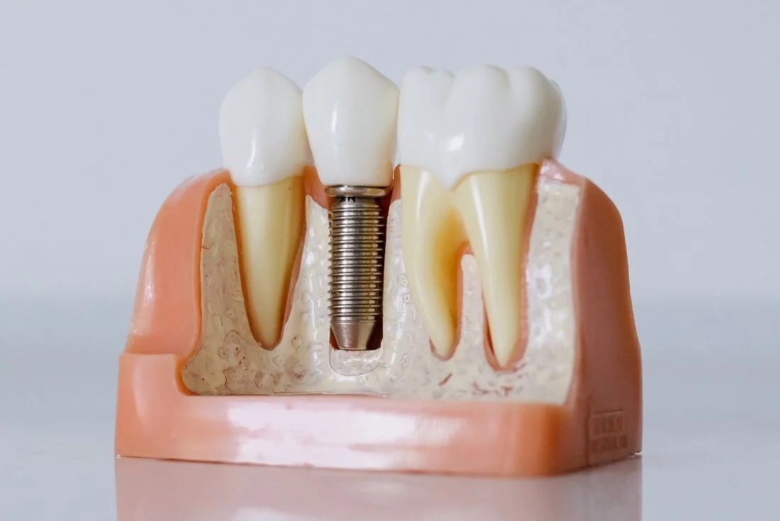 Bohemia Dentist Dental Implants