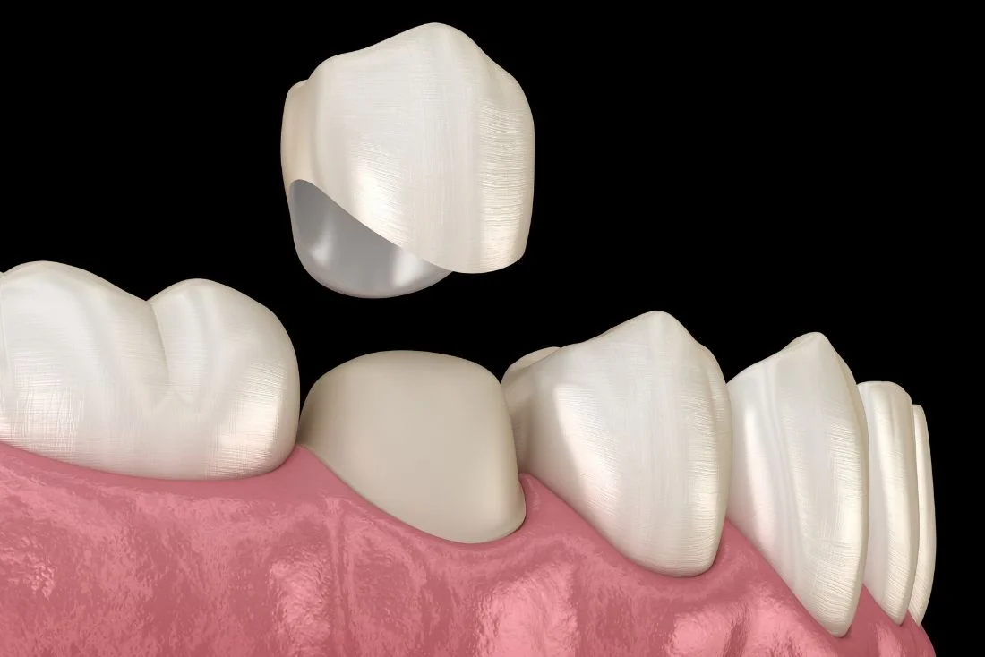 Dentist Bohemia NY Dental Crowns